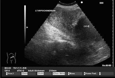 Figure 2 Figure 2: Ultrasound showing uterus draping over the cystic lesion in the left hypochondrium.