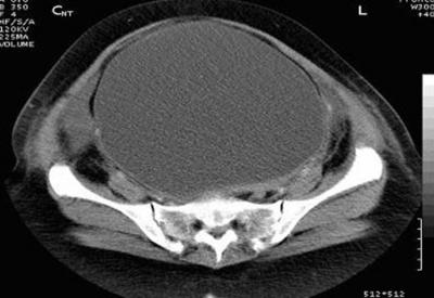 bladder appearing as cyst Figure 5 Figure 5: CECT showing non opacification of ureters Imaging findings confirmed a large abdominopelvic