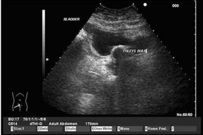 Figure 6 Figure 6: Post catheterization ultrasound showed near empty bladder patient retains a substantial amount of urine after every void.
