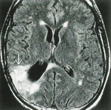 suggestive of high grade transformation of this previously low grade glioma.