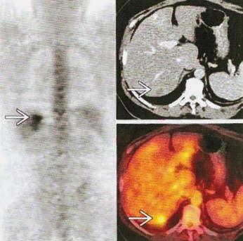 Carcinoma Metastasis PRIMARY BONE NEOPLASMS 17 (Left) Axial