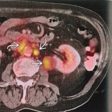 RENAL CELL CARCINOMA (Left) Axial contrast enema shows a low attenuation mass g arising from the medial aspect of the left