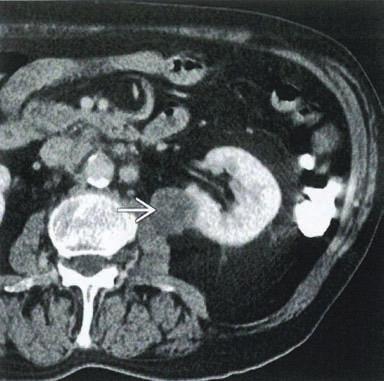 (Right) Axial fused PET/CT shows mild to moderate increased FDG activity within the left renal mass g with moderately