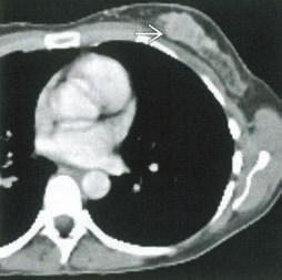 Coronal PET (A), axial CT (B) and fused PET/CT (C) show a focal area of intense FDG activity g, corresponding to primary colon carcinoma in the proximal ascending colon.