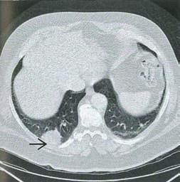 Lung Cancer t Distinguish malignant pulmonary nodules from benign ones.