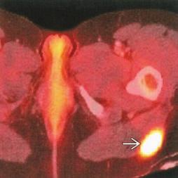 (Left) Axial CECT shows a normal-sized left common iliac lymph node g, not identified prospectively on
