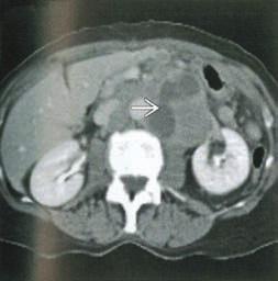 (Right) Axial fused PET/CT shows the same lesion with intense FDG uptake g, compatible with a primary