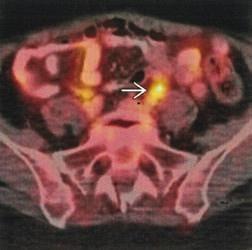 (Right) Axial fused PET/CT shows focal intense FDG activity correlating with the lesion in the left
