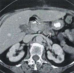 Pancreatic Cancer Differentiation of benign processes such as pancreatitis, mucinous cyst adenoma and