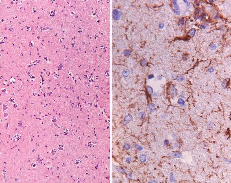 434 J Neurooncol (2012) 106:431 435 Fig. 3 Initial brain biopsy. The left hand panel shows hematoxilin eosin-stained section of cortical tissue with slight increase in cellularity (objective 92.5).