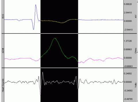 In any particular ECG complex you will see two pulses of sound. Pick a particularly clean set of pulses from any one complex.