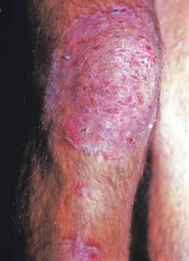 FOCUS Psoriasis squamous cell carcinoma. Psoriasis is almost always symmetrical. If in doubt do a skin biopsy. T cell tumours of the skin (eg.