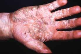 Uncommon forms of psoriasis The most common form of psoriasis is chronic plaque psoriasis (about 80% of cases). However, occasionally you may come across other forms. Guttate psoriasis.