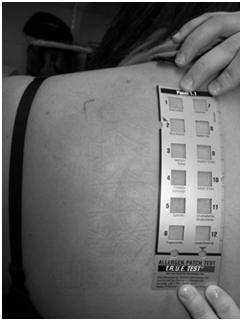 ICD vs ACD= Patch Test A Note on Dyshidrotic Eczema This