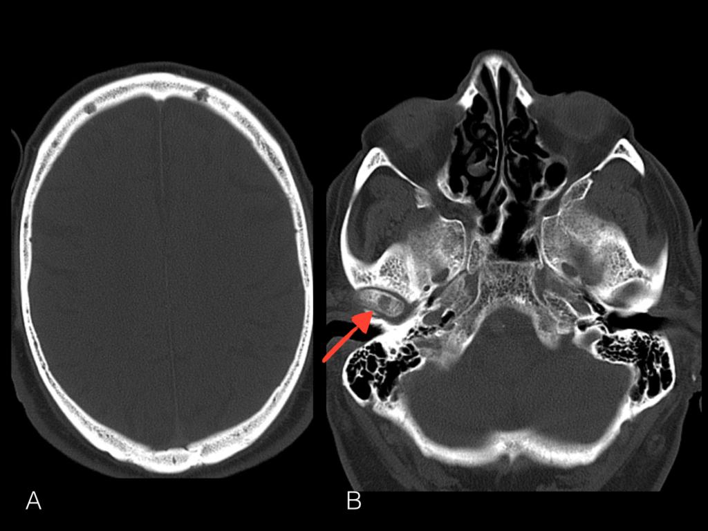 Fig. 4: Axial Bone window on head CT scans of a multiple myeloma patient with small osteolytic