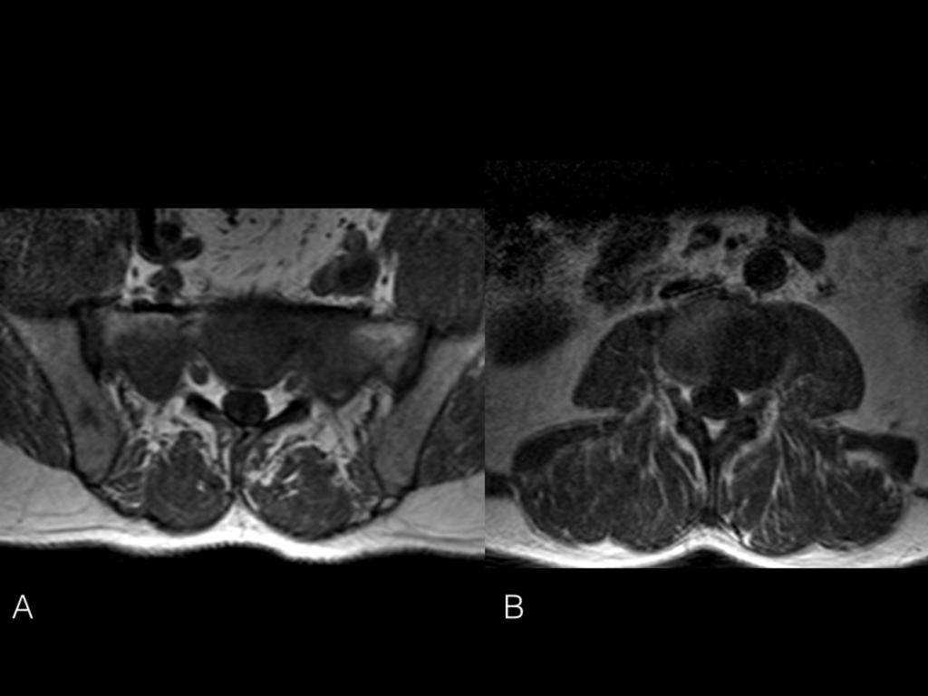Fig. 7: Axial MRI T1 Weighted images from a myeloma patient with focal lesions on the sacrum and right iliac crest