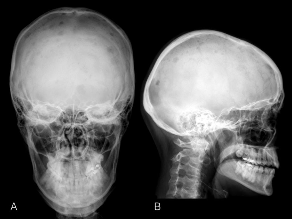 Fig. 1: A and B - Anteroposterior and lateral skull plain X-rays that show innumerous diffuse lytic