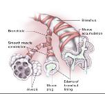 Obstructive Pulmonary Diseases Asthma Bronchospasm, edema, mucus