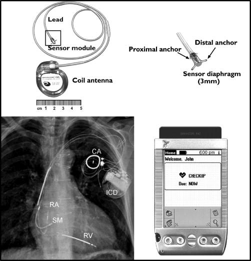 HeartPOD Used in patients with heart failure to optimize therapy by monitoring left atrial pressures.