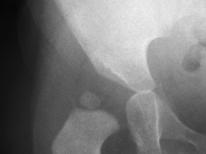 The bipartite acetabulum is seen on plain radiographs in older children (Figure 1) but it can require an arthrography to demonstrate it in the younger child (Figure 2).