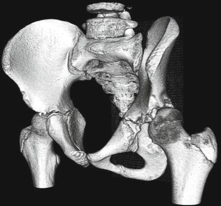 Triple Pelvic Osteotomy Peter Templeton and Peter V. Giannoudis 2 Indications Acetabular dysplasia with point loading, lateral migration, and painful limp.