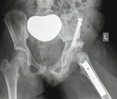 Pelvic osteotomies for the treatment of hip dysplasia in children and young adults. J Am Acad Orthop Surg.