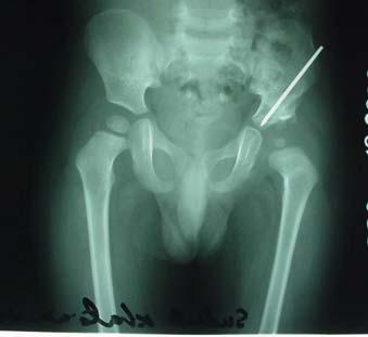 This case was the same child with avascular necrosis of the femoral head, subluxation of femoral head and preoperative 3.5cm leg length discrepancy.