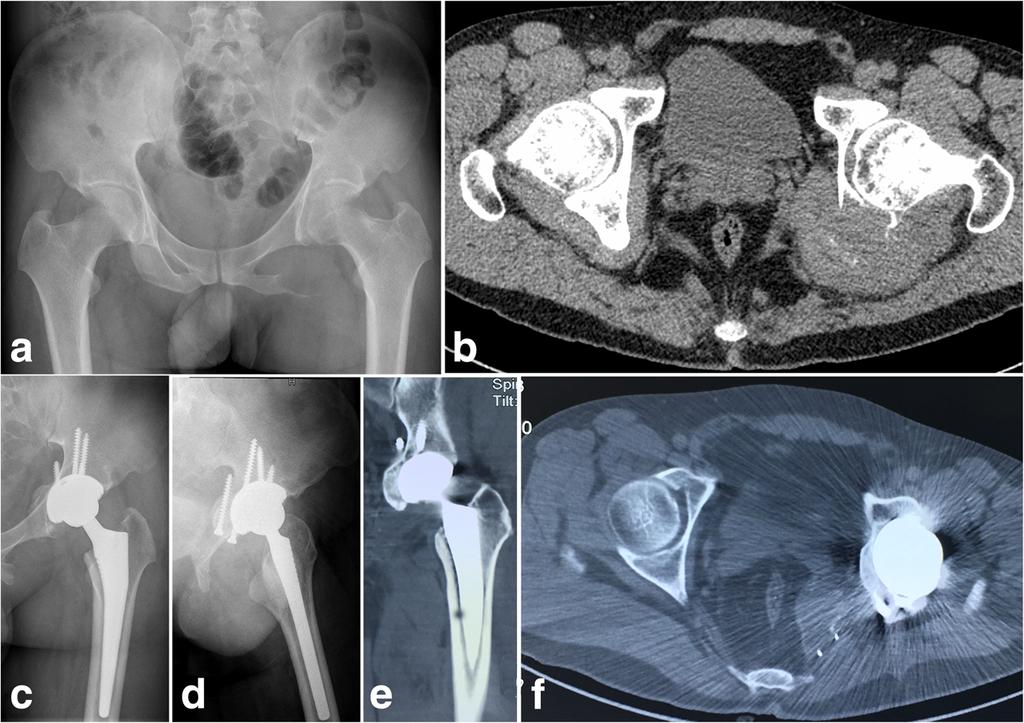 b The reamed socket was prepared The treatment of pelvic GCTs involving acetabulum is usually difficult and controversial.