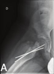 The patient suffered a nondisplaced pathological femoral neck fracture, treated at another centre with closed reduction and internal fixation using two K wires.