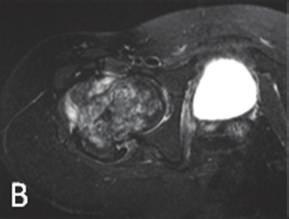 Initial magnetic resonance imaging (MRI) showed a proximal femur lesion extending distally 13 cm, with a surrounding soft-tissue mass.