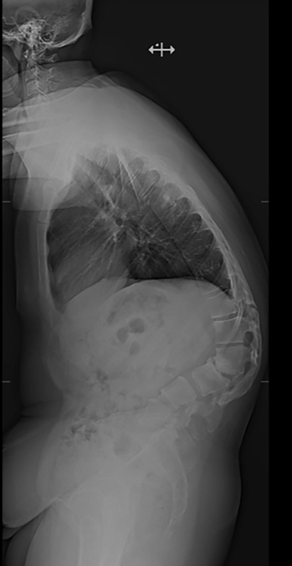 FIGURE 2: Preoperative Lateral Radiograph 2016 Molloy