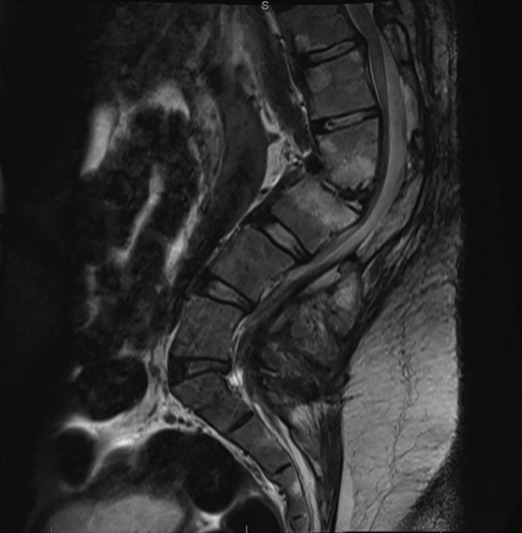 Preoperative lateral radiograph demonstrating standing posture and acute kyphosis at L2-L3 FIGURE 3: Preoperative Sagittal MRI T2 weighted sagittal MR image demonstrating kyphosis at L2-L3 and spinal