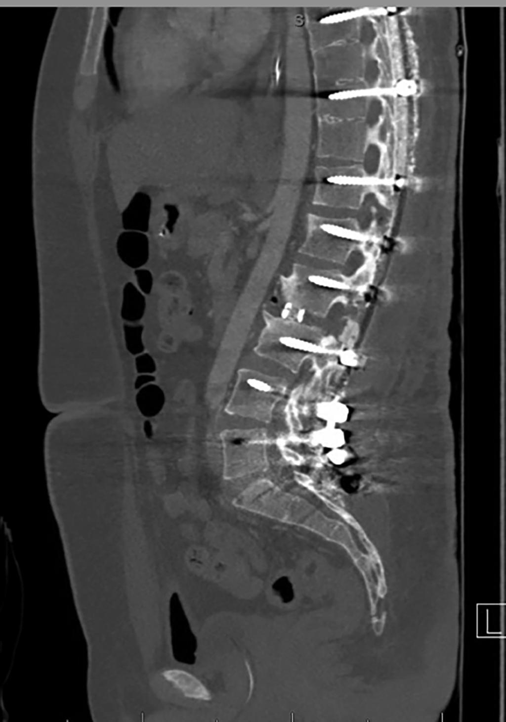FIGURE 5: Postoperative Sagittal CT Image Immediate postoperative sagittal CT image demonstrating satisfactory placement of hardware, and complete correction of kyphotic deformity using Ponte