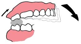 anteriorly, makes allowance for a contracting orbicularis oris muscle which might otherwise displace the denture backwards.