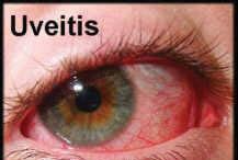 Arthritis can lead to blindness Slit Lamp Exam Chronic Anterior Uveitis True some