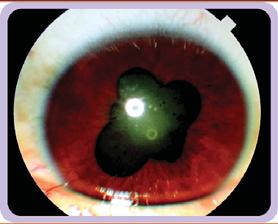 Late Uveitis -Posterior Synechiae Weblike attachment pupillary margin to anterior