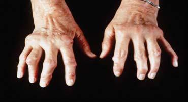 Rheumatoid Arthritis Adult Juvenile Idiopathic Arthritis < 16 years