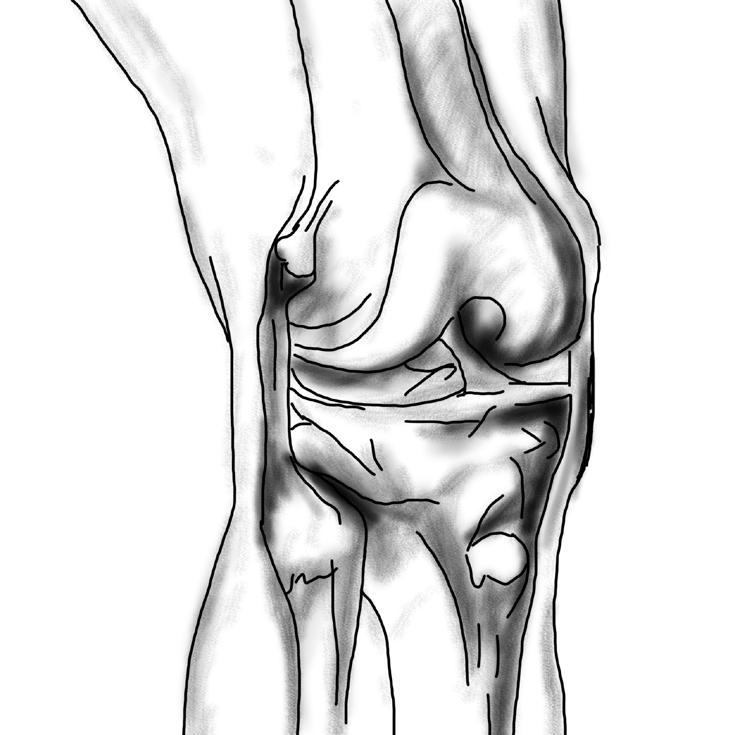 KNEE REPLACEMENT SURGERY YOUR OPERATION A HEALTHY KNEE Your knee has become diseased or injured. Simple movements like standing or walking may hurt.