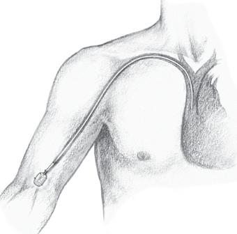 A small incision is made on your chest or arm to create a space or pocket for the port and a tunnel for the catheter. The port is inserted under the skin and into the pocket.