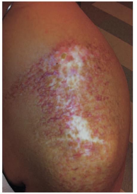 Late skin toxicity 20 years post Neutron RT for osteosarcoma