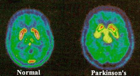 Parkinson s Disease The brain does not produce enough of the neurotransmitter that transmits messages from the brain to the