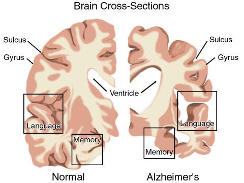 Alzheimer s Disease A gradual shrinking of the neurons in the cerebrum