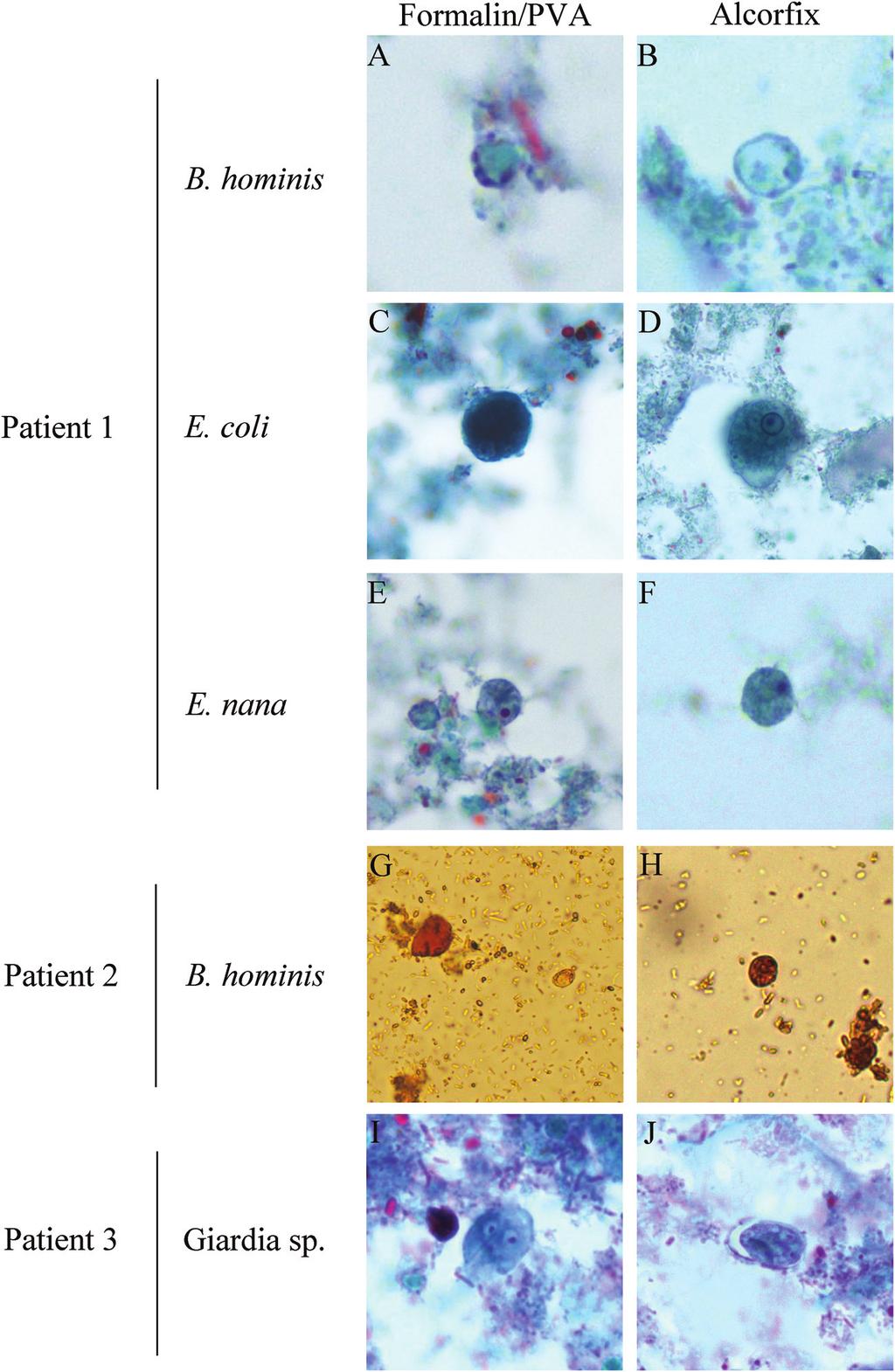 Couturier et al. Downloaded from http://jcm.asm.org/ FIG 2 Positive stool specimens cocollected in PVA-formalin and Alcorfix. Representative protozoa are shown for both fixative types.
