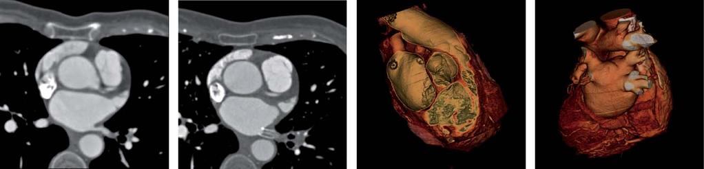 CTA reveals tumor infiltration of the left atrium (A, B) via the right upper pulmonary vein from a lung cancer involving the right upper lobe (C).