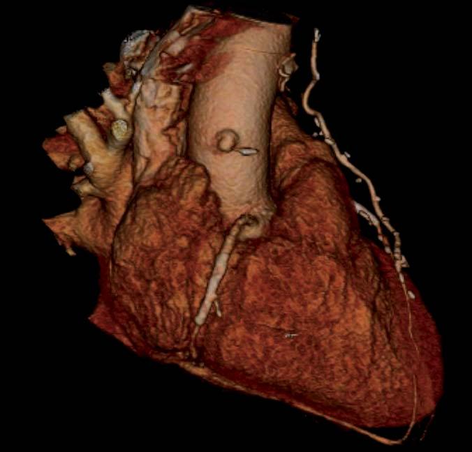 J Thorac Imaging Volume 22, Number 1, February 2007 EVALUATION OF CAD BEFORE NONCARDIAC SURGERY Although currently the role of preoperative CTA is still uncertain, 9 its potential before noncardiac