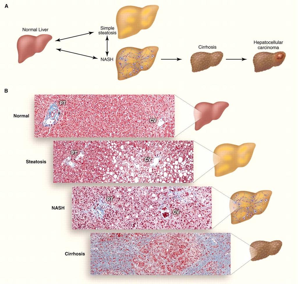 Spectrum of Nonalcoholic Fatty Liver Disease (NAFLD) Who is at risk? BIOMARKERS How can we diagnose? Can we differentiate disease phenotypes?
