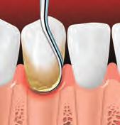 Scaling and Root Planing Scaling removes plaque and tartar from below the gumline. Root planing smoothes the tooth root and helps the gums reattach to the tooth.