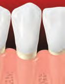 Periodontal Surgery If the pockets do not heal enough after scaling and root planing, periodontal surgery may be needed.