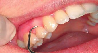 Infected pocket Pockets between your teeth and gums collect bacteria, which can cause them to get infected and inflamed.