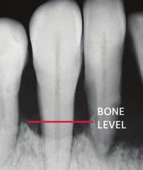 X-ray showing bone loss. Follow these healthy habits to help prevent gum disease: Brush your teeth twice a day with fluoride toothpaste for 2 minutes each time.